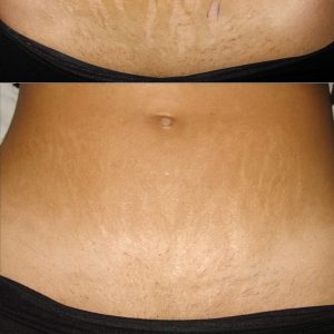 Karboksyterapia